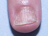 Longitudinale groeven bij alopecia areata