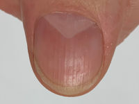 Nagelafwijkingen bij het nail-patella syndroom