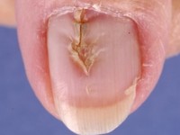 Mediane canaliforme nagel dystrofie