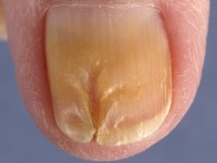 Mediane canaliforme nageldystrofie van Heller