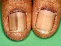 Melanonychia striata