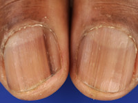 Melanonychia striata