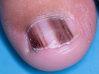 Melanonychia striata