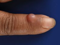 Digital mucoid cyst, myxoid cyste