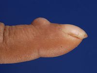 Digital mucoid cyst, myxoid cyste