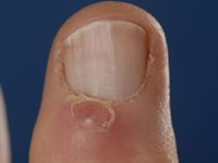 Digital mucoid cyst, myxoid cyste