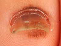 Naevus naevocellularis