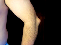 Nagelafwijkingen bij het nail-patella syndroom