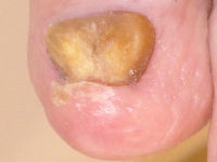 Onychauxis (te dikke nagel)