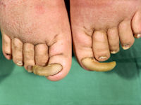 Onychogryphosis