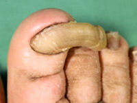 Onychogryphosis