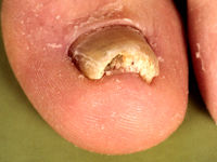 Hyperkeratotische nagel