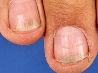 Distale onycholyse door doxycycline