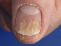 Onycholysis semilunalis