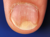 Onycholysis semilunalis