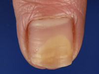 Onycholysis semilunalis