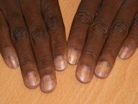 Onychomadesis after toxic epidermal necrolysis