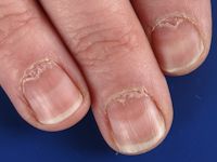 Onychomadesis in alopecia areata