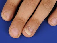 Onychomadesis after hand, foot and mouth disease