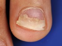 Onychomadesis after hand, foot and mouth disease