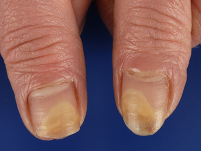 Onychomycosis