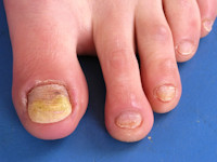 Onychomycose