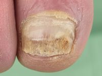 Onychomycosis