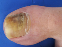 Onychomycose, schimmelnagels