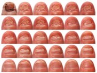 Uitgroei gezonde nagel onder antimycotica