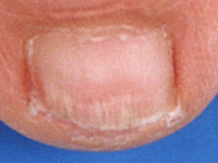 Onychoschizis