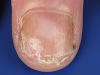 Onychoschizis