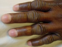 Pachydermoperiostosis