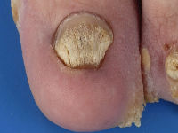 Pachyonychia congenita