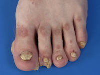 Pachyonychia congenita