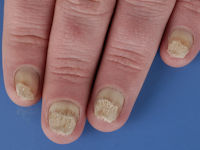 Pachyonychia congenita