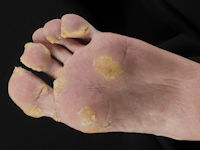 Pachyonychia congenita