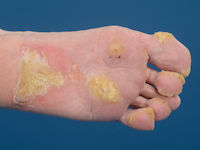 Pachyonychia congenita