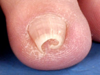 Pincer nail (buisnagel, pincetnagel)