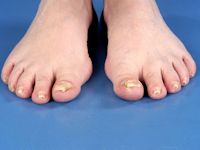 Pincer nail (buisnagel, pincetnagel)