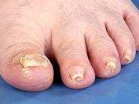 Pincer nail (buisnagel, pincetnagel)