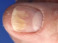 Distale onycholysis bij pityriasis rubra pilaris