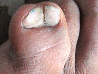 Polydactylie