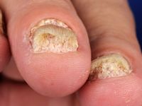 Nail psoriasis