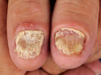 Nagel psoriasis