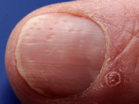 Nagel psoriasis (putjesnagels)