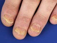 Nagel psoriasis