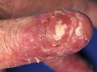 Nail psoriasis