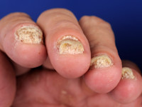 Nagel psoriasis (subunguale hyperkeratose)