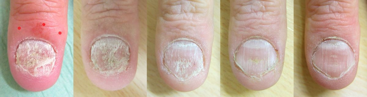 Behandeling van nagelpsoriasis met intralesionale corticosteroiden