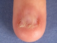 Dorsaal pterygium bij lichen planus